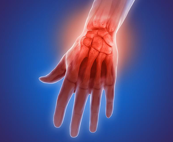 Se puede trabajar con artritis reumatoide
